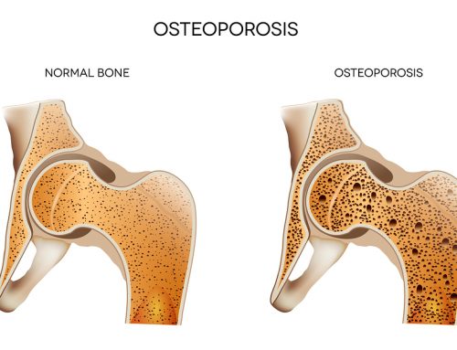 Five Ways for Your Senior to Keep Living Her Best Life with Osteoporosis