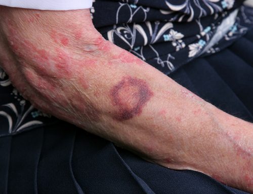 Home Health Care: When Should You Worry About Bruises?