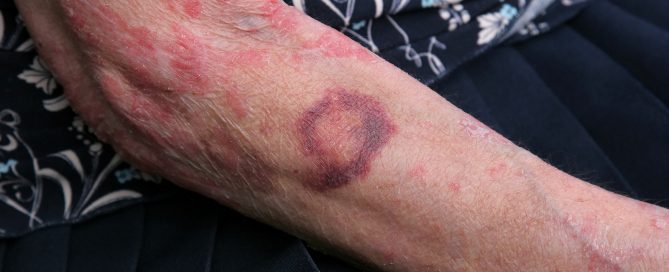 Home Health Care in Alexander City AL: Senior Bruises