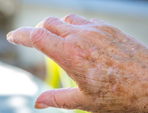 Elder Care: Why Is Your Mom’s Skin Flaky and Dry?